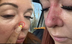 Sıradan bir sivilce sandı, ama hayatı altüst oldu Her yıl 2 binden fazla kişinin ölümüne yol açıyor