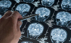 Alzheimerda yeni umut: Erken evrede teşhisi mümkün kılacak kan testi ABDde onaylandı