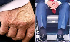 Morlukların sebebi belli oldu… Trump’ta kronik hastalık çıktı