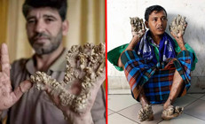 Vücudu ağaç kabuğuna dönüştüren hastalık “Ellerimi kesin” diye yalvardı