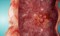 Divertiküler kanama nedir, neden olur