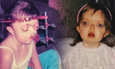 Nadir bir genetik durumla doğdu, doktorlarını bile şaşırttı... Yıllarca meraklı bakışlara maruz kaldı Nasıl başardığını anlattı