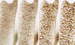 Kemik erimesi neden olur Kemik erimesine karşı 6 etkili önlem