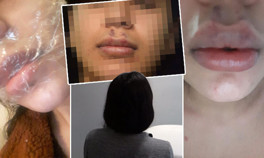 Mağdur kadının anlattıkları akıllara durgunluk verdi: ‘Koronalı botoks partisi…’