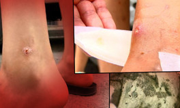 İstanbulda sivrisinek paniği Herkes tedirgin: Çocuklarda yaralar oluştu