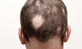 Alopesi Areata hastalığı nedir Saçkıran hastalığı neden olur, tedavisi var mı