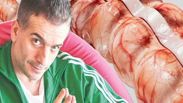 Ağrısız gelişiyor, sinsice ilerliyor Murat Cemcir’i yoğun bakımlık eden hastalık divertikül kanaması