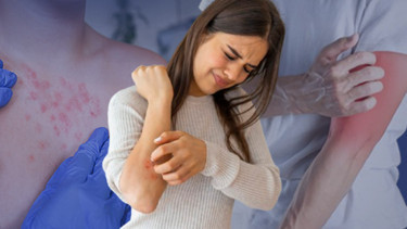 Acil servislerde yoğunluk arttı: Sessizce yükselen uyuz tehlikesi ‘Genellikle bu iki şikâyetle başvuruyorlar’ | NASIL ÖNLEM ALINMALI