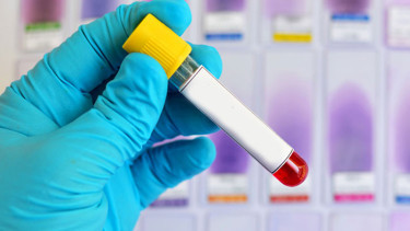 Alzheimer riskini öngören yeni bir kan testi yolda Tam olarak ne zaman hazır olacak