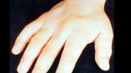 Bu hastalığa dikkat