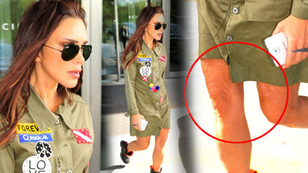 Seren Serengilin bacağına ne oldu