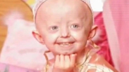 Vücudu 100 yaşında olan 17 yaşındaki Hayley Okines öldü