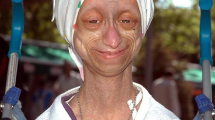 Fanatik Fenerbahçeli erken yaşlılık hastası Gamze’nin ölümü Kayseri’de üzüntü yarattı