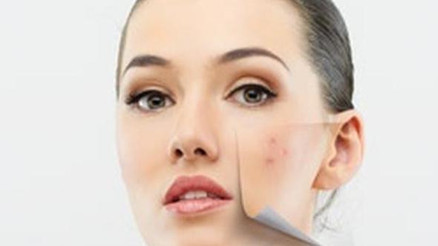 Sivilce- sivilce lekeleri ve uçuk nasıl geçer