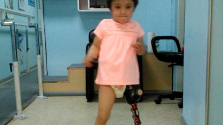 Özge bebek yeni protez bacağıyla daha az düşüyor