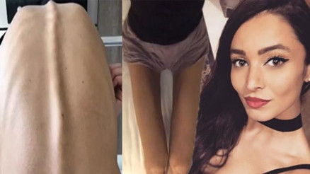 Ayşe Akından anoreksiya hastalığı fotoğrafları