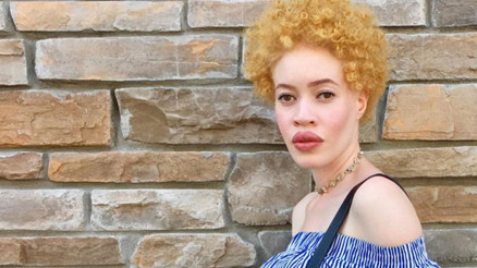 Dünyada bir ilk: Albino model makyaj markasının yüzü oldu Dünyada bir ilk: Albino model makyaj markasının yüzü oldu