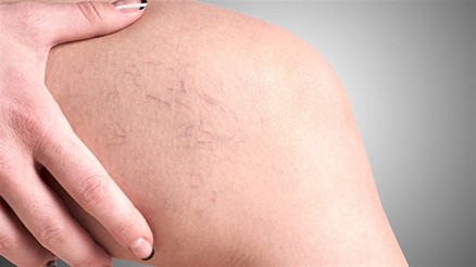 Varis tedavisinde gelinen son nokta: Venablock