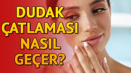 Dudak çatlaması nasıl geçer Dudak çatlaması tedavisi