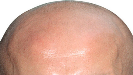 Kelliğe çare bulundu Bakın çözüm neymiş