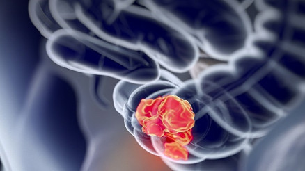 İnce bağırsak kanseri nedir İnce bağırsak kanseri nedir