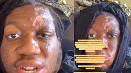 Ünlü rapçi et yiyen bakteri kaptı