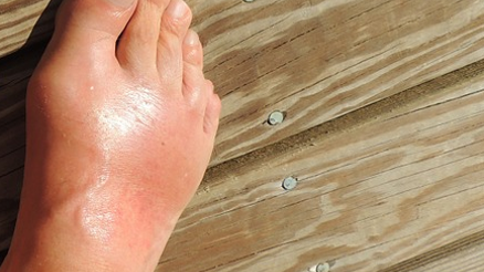 Gut hastalığı nedir Ürik asit neden yükselir