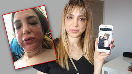 Estetik mağduru kadının yüzü tanınmaz hale geldi
