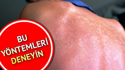 Güneş yanığına ne iyi gelir Güneş yanığı nasıl geçer