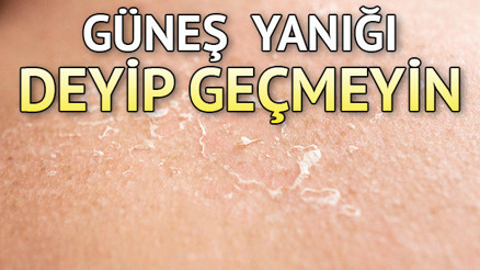 Güneş yanığı nasıl geçer Güneş yanığına ne iyi gelir