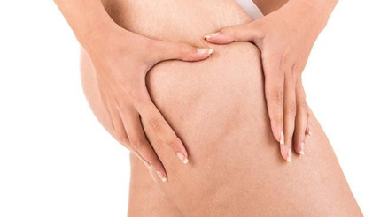 Selülit Oluşumunun Nedenleri