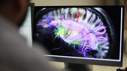 Savant sendromu nedir Savant otizmi belirtileri nelerdir