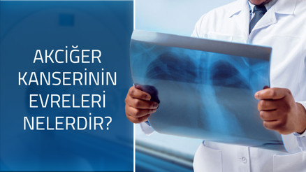 Akciğer kanserinin evreleri nelerdir Akciğer kanserinin evreleri nelerdir