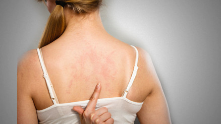 Egzamaya ne iyi gelir ve nasıl geçer Egzama neden olur Evde egzamaya iyi gelen bitkisel çözümler ve doğal yöntemler