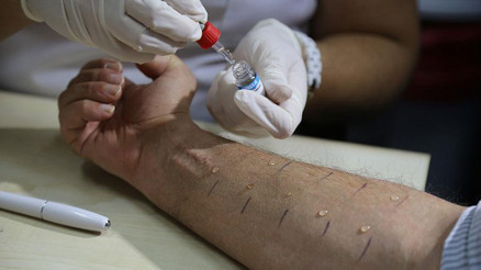 Kaşıntıya ne iyi gelir ve nasıl geçer Kaşıntı neden olur Evde kaşıntıyı geçiren bitkisel çözümler ve doğal yollar