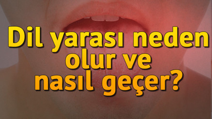 Dil yarasına ne iyi gelir, neden olur, nasıl ve kaç günde geçer Dil yarasına evde kesin çözüm önerileri Dil yarasına ne iyi gelir, neden olur, nasıl ve kaç günde geçer Dil yarasına evde kesin çözüm önerileri
