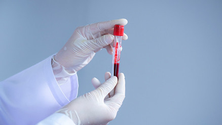 PRP nedir PRP tedavisi ne işe yarar PRP nedir PRP tedavisi ne işe yarar