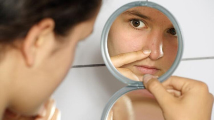 Sivilce izleri nasıl geçer Sivilce lekeleri için doğal yöntemler