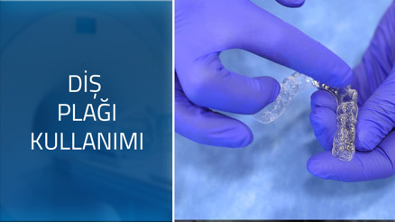 Şeffaf plakların kullanım süresi nedir