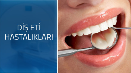 Diş eti hastalıklarının belirtileri nelerdir