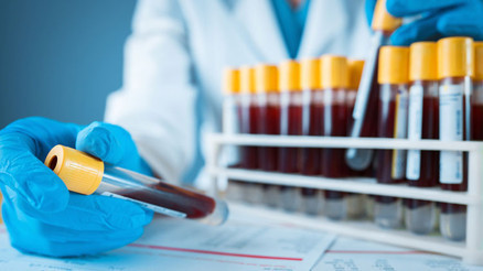 Lipaz (lpl) nedir Lipaz değeri kaç olmalıdır Düşüklüğü ile yüksekliği nedenleri ve belirtileri Lipaz (lpl) nedir Lipaz değeri kaç olmalıdır Düşüklüğü ile yüksekliği nedenleri ve belirtileri