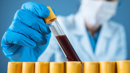 Alp nedir Alp değeri kan tahlilinde kaç olmalıdır Düşüklüğü ile yükseliği nedenleri ve belirtileri Alp nedir Alp değeri kan tahlilinde kaç olmalıdır Düşüklüğü ile yükseliği nedenleri ve belirtileri