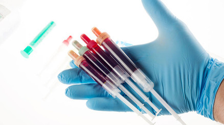 Anti TG (Anti Tiroglobulin) nedir Anti TG değeri kaç olmalıdır Düşüklüğü ile yüksekliği nedenleri ve belirtileri