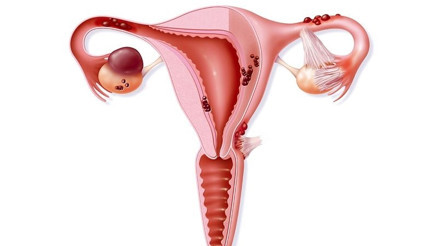 Miyom nedir Miyom tedavisi nasıl yapılır