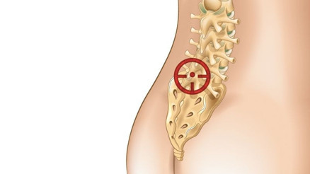 Bel fıtığı tedavisi nasıl yapılır Bel fıtığı tedavisi nasıl yapılır