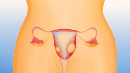 Kadınların kabusu miyom: Belirtileri, çeşitleri, tedavisi