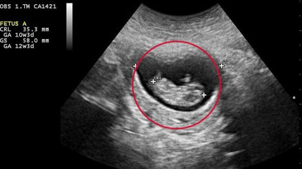 Gebelik kesesi ne zaman görülür Gebelik kesesi ne zaman görülür