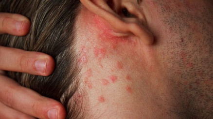 Uyuz vakaları üç kat arttı, salgın gibi yayılıyor