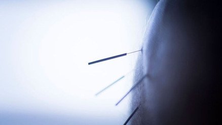 Kuru iğneleme tedavisi kas ağrılarını ameliyatsız tedavi ediyor Kuru iğneleme tedavisi kas ağrılarını ameliyatsız tedavi ediyor