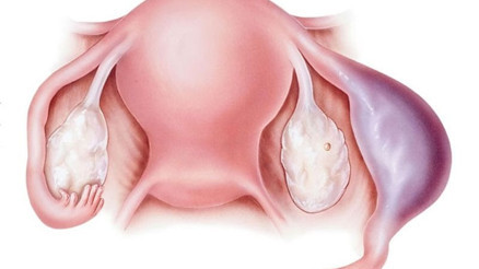 Dış gebelik nedir Dış gebelik neden olur